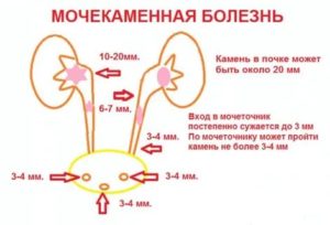 Диета после операции по удалению камня из мочеточника