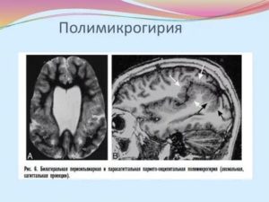 Каковы последствия полимикрогирии?