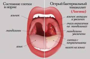 Увеличены миндалины, красное горло без температуры