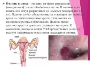 Боли в области матки от норколута
