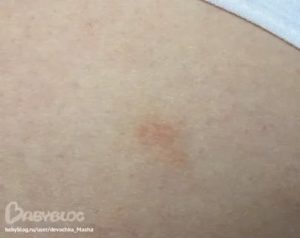 Сухая и шелушащаяся кожа спины с огрубевшими пятнами больше года