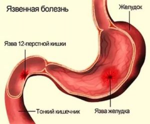 Язва дпк обострение, температура 37,6