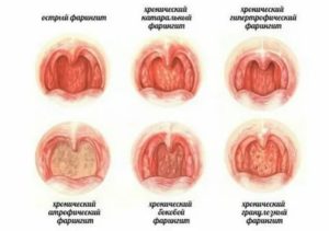 Сухость в горле и покраснение задней стенки глотки