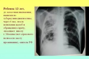Может ли за месяц после хорошей флюрографии появиться туберкулёз