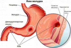 Язва дпк обострение, температура 37,6