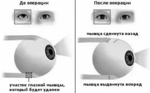 Косоглазие после операции какие можете дать рекомендации