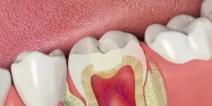 Больно ли менять пломбу на живом зубе?