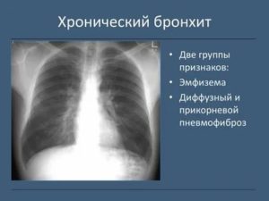 Признаки бронхита на рентгене