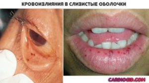 Зуд слизистых оболочек