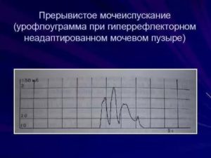 Прерывистое мочеиспускание