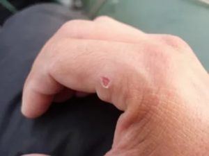 Ранка на руке, не гноится но постоянно кровоточит