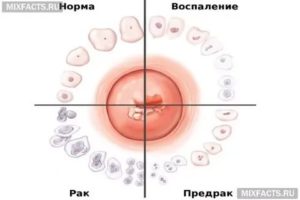 Лечение ВПЧ и прижигание эрозии шейки матки