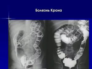 Болезнь крона у ребёнка