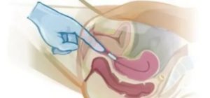 Применение виферона при месячных вагинального