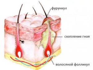 Как ухаживать за фурункулом с резинкой?