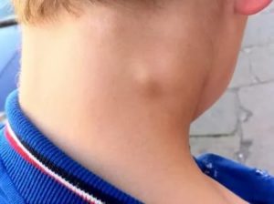 Лимфоузлы на шее у ребёнка