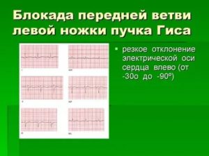 Блокада передней ветви левой ножки п. Гиса у ребенка