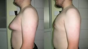 Увеличение одной молочной железы