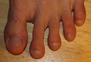 Проблема с пальцами ног. Выделение жидкости и опухание