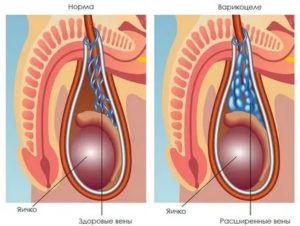 Беспокоит темно-фиолетовая вена на левом яичке