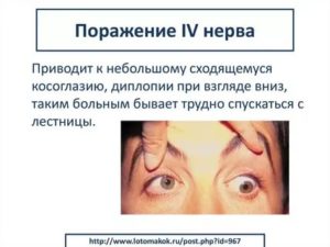 Двоение глаза при взгляде вверх и вниз