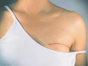 Фиброаденома, болит подмышкой, плечо