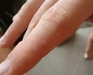 Водянистые высыпания в виде пузырьков между пальцами ног