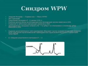 WPW синдром