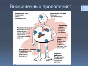 Болезнь крона у ребёнка