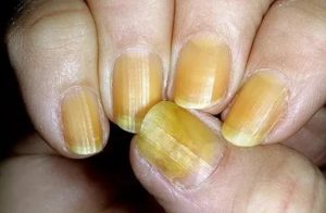 Желтые пятна на ногтях