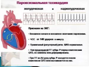 Хроническая тахикардия после испуга