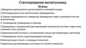 Стентирование мочеточника