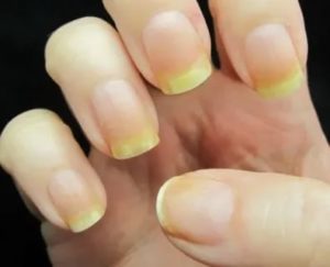 Желтые пятна на ногтях