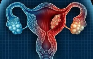 Киста яичника и полип