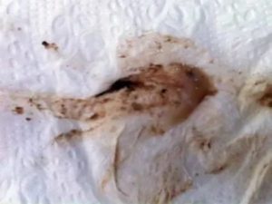 Коричневые выделения на 30 неделе