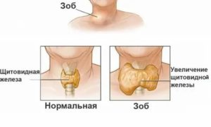 Увеличена левая доля щитовидной железы