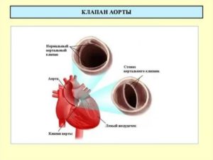 Что делать если в аортальном клапане 2 створки вместо 3?