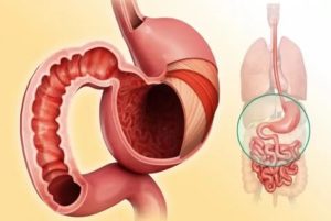 Недостаточность кардии, гастрита, дуоденита