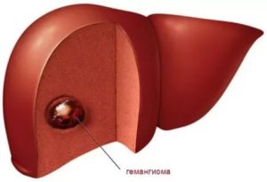Беременность при гемангиомах в печени