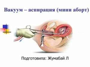 Вакуумный аборт после замершей беременности