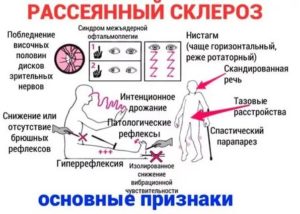 Рассеяный склероз или ВСД?