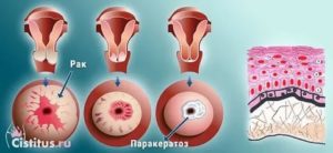 Биопсия шейки матки Очаговый паракератоз