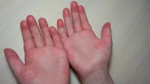 Красные пятна у основания большого пальца (на двух руках)