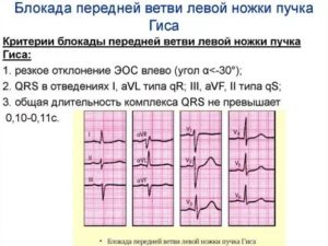 Блокада передней ветви левой ножки п. Гиса у ребенка