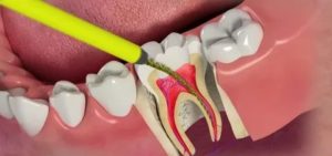 Боль после лечения зуба в десне
