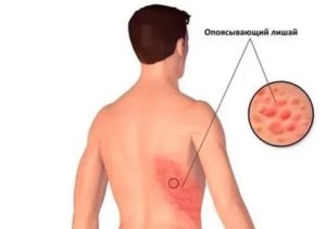 Зуд после опоясывающего лишая