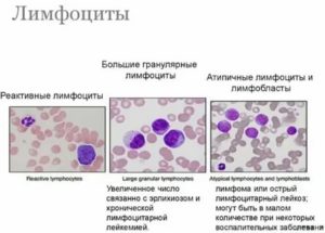 Повышены реактивные лимфоциты