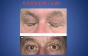 Дергается нерв под глазом при беременности