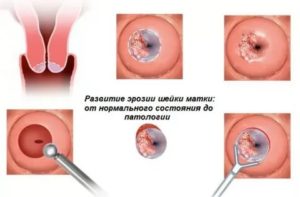 Кровотечение после лазерной вапоризации шейки матки