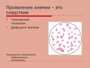 Гипохромия I. Пойкилоцитоз I у 6-ти месячного ребенка